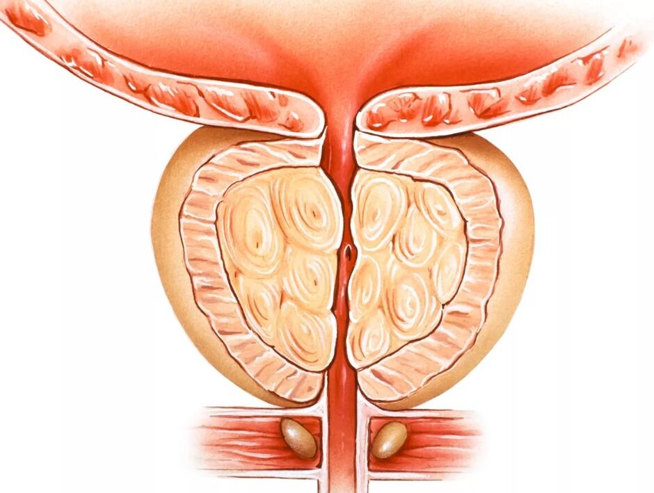 Zapalenie prostaty