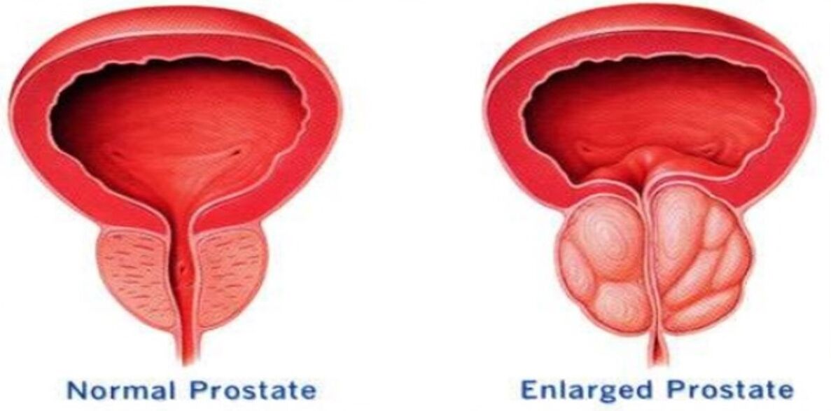 Normalna prostata, zapalenie prostaty